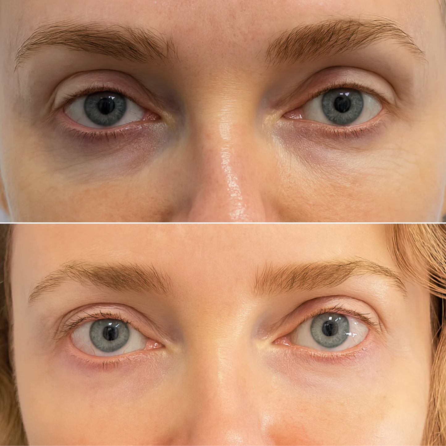 EInuvo™: Red Light Therapy That Deflates Eye Bags